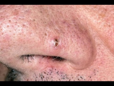 blackheads 2021 new  | Pimple Popper