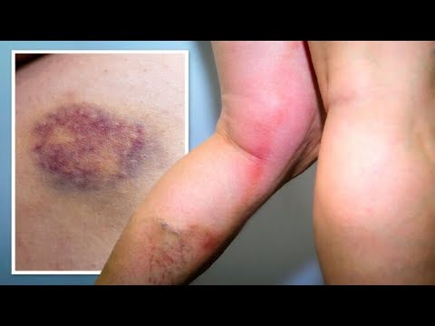 How to Get Rid of Bruises | 5 Home Remedies for Bruises