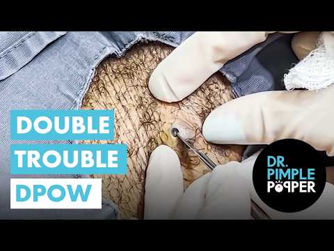 A Double Trouble Dilated Pore of Winer