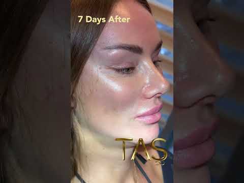 Transformative Facelift Experience with Dr. Tas: Unveiling Timeless Beauty