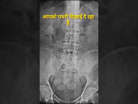 Kidney Stone Dikhai de raha hai