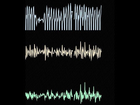 How AI Gets Your HeartBeat!  Episode 2: Apps and Algorithms in Rhythm Detection