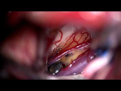 The pretemporal approach to anterolateral midbrain cavernous malformations