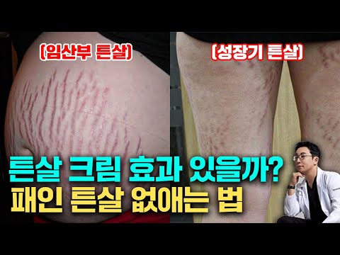 성장기 튼살, 튼살 없애는 방법과 관리 예방법, 튼살 치료 시기(피부과 전문의 오가나)