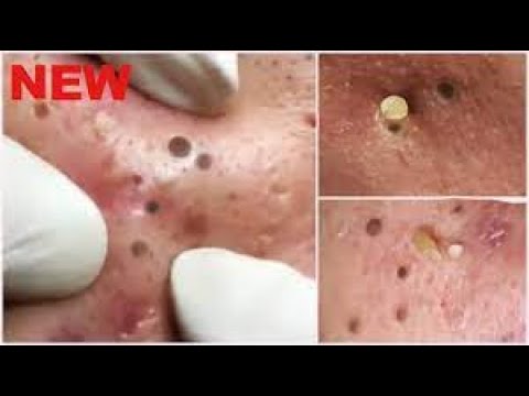 new Removing of Blackheads this week