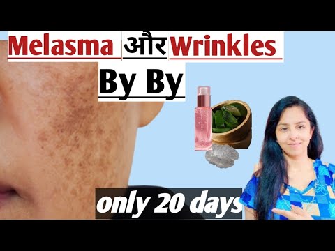 मुश्किल से मुश्किल *झाइयाँ MELASMA HYPERPIGMENTATION* हों , करें 100% इलाज़ सिर्फ 20 दिनो में