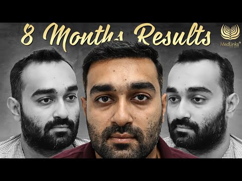 Best Hair Transplant Results in 2024 | Stunning Before and After Results | MedLinks