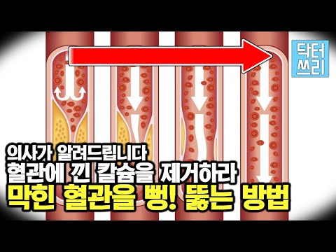 혈관에 낀 "칼슘"을 제거하라 - 막힌 혈관을 뻥 뚫어줄 "1인자"는?