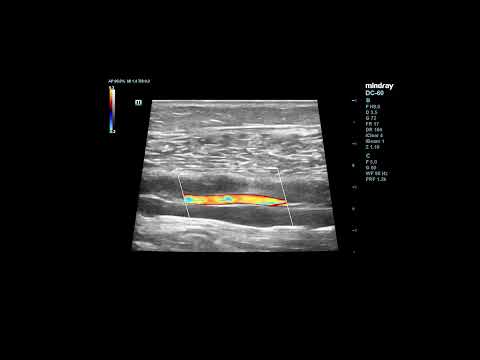 Posterior tibial artery with the accompanying veins  (Duplex Ultrasound) #shortsvideo