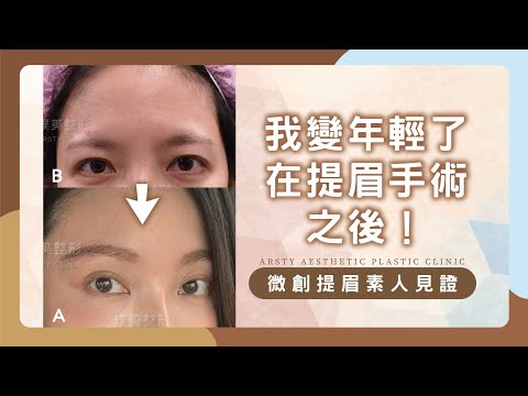 【微創提眉術後素人見證】我變年輕了在提眉手術之後！| 璞美整形外科醫美診所