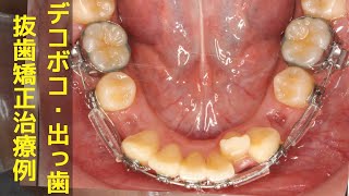 【矯正・前歯のガタガタ・出っ歯】抜歯ワイヤー矯正治療例│叢生と上顎前突│crowding projecting teeth