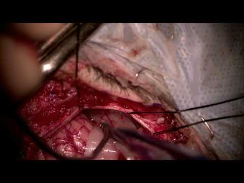 Posterolat route for midbrain cavernous malformation reaching anterior surface of the brainstem