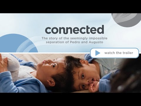 connected documentary trailer || conjoined twins separation || Dayton Children's Hospital