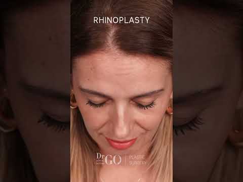 Rhinoplasty Transformation by Assoc. Prof. Dr. Güncel Öztürk | Before & After Results