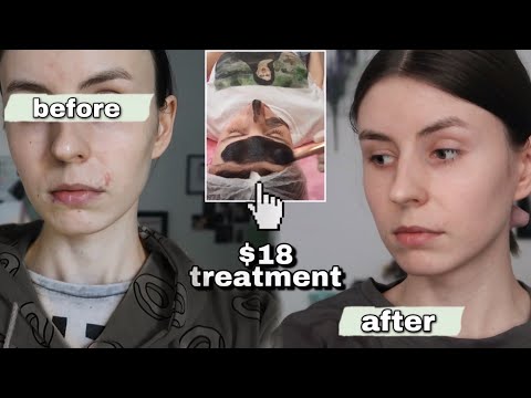 this $18 treatment helped my acne in 3 weeks