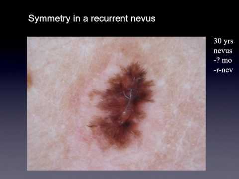 Recurrent nevus or melanoma - Dr. Andreas Blum