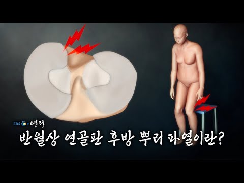 [명의 의학백과📖] 반월상 연골판 후방 뿌리 파열이란?