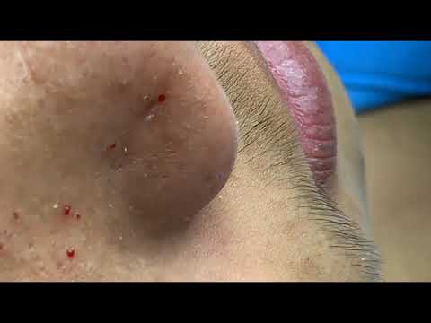 Acne Removal | Whithead Treatment 2019