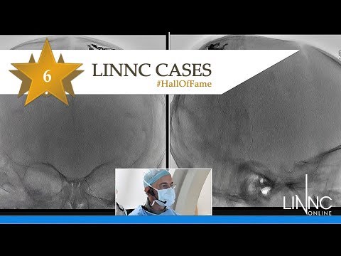 Live case treatment of a VGAM