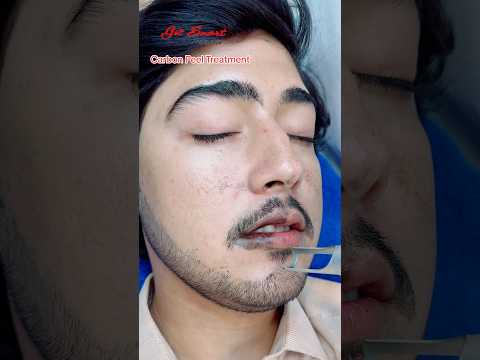 Carbon Peel Laser Treatment  #getsmarthairclub #viralvideo #beauty  #laserhairtreatment #laser