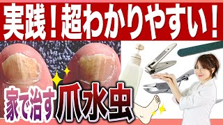 【家で水虫治療】これって水虫？家にある爪切りと薬でセルフ処置法？薬はどれ？必要なアイテム大公開！早速やってみよう、お家でできる正しいケア！