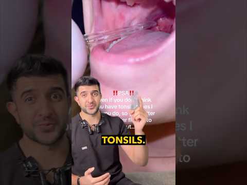 If You Have Tonsil Stones, WATCH THIS! 😮🦷