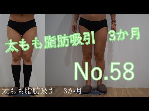 太もも脂肪吸引　58　「手術前より筋肉多めですね」と話していた方のビフォーアフター