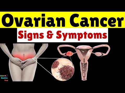 What are the Signs and Symptoms of Ovarian Cancer | Ovarian Cancer Signs and Symptoms