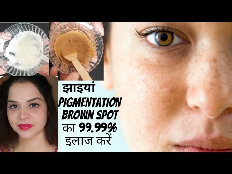 Pigmentation,झाइयां acne scars pimple marks dark spot sun spot काले दाग का 100% इलाज,पाएं clear skin