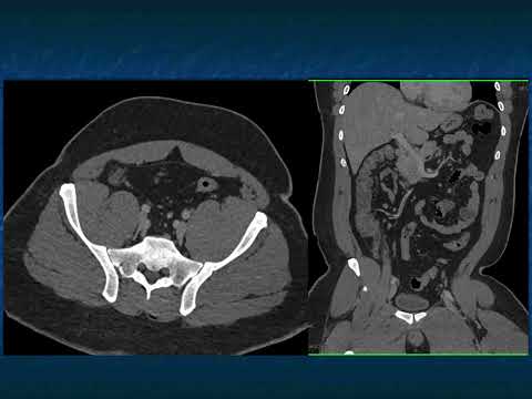 CT Evaluation of the Appendix: Appendicitis and Beyond - Part 1