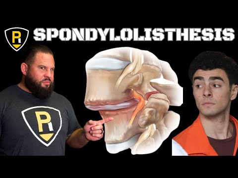 Spondylolisthesis (WHAT IS IT?)