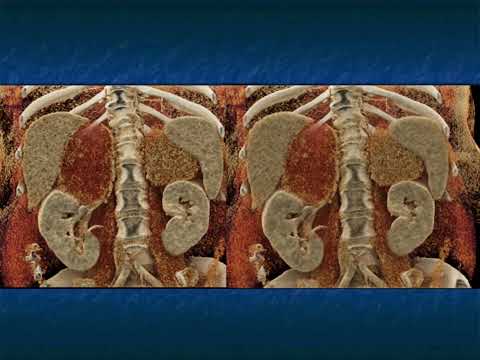 CT of the Large Adrenal Mass: Follow, Biopsy, Resect - Part 3