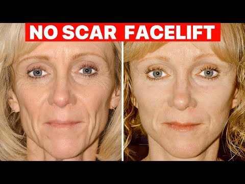 Scarless Facelift - Plastic Surgeon Explains