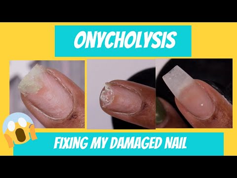 Onycholysis |Uuggghh I damaged my nail | Fixing my separated, damaged nail