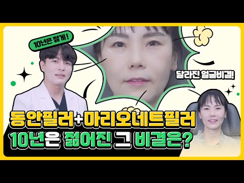 10분만에 10년 어려지는 동안필러, 마리오네트 필러 반반시술로 효과 보여드립니다!