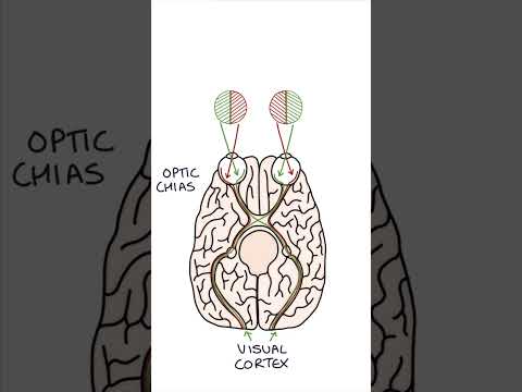 Bitemporal Hemianopia #medicine #clinicalexamination #ophthalmology