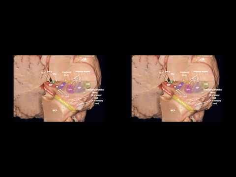 Subtemporal transtentorial approach for resection of a pontomesencephalic cavernous malformation