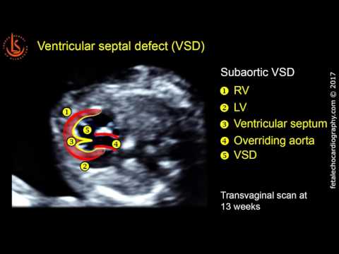 Fetal echocardiography at 11-13 weeks: Ventricular Septal Defect (VSD)