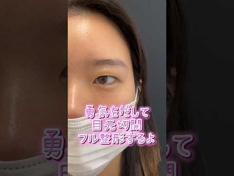 勇気を出して目元フル整形するよ#湘南美容クリニック京橋院 #目尻切開 #全切開二重術 #目尻切開 #目元切開