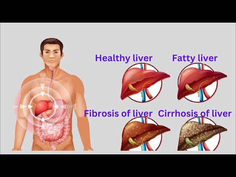 The Silent Clues In Liver Disease - Weight Loss And Muscle Wasting In Liver Disease