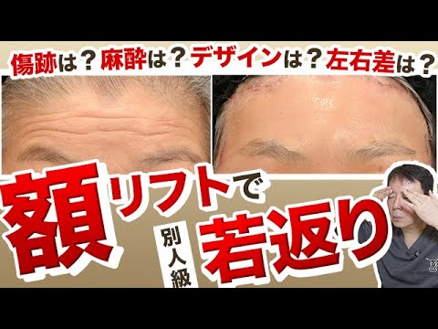 【額リフト】まるで別人?! おでこのシワを消し、重たい瞼を軽くする額リフトを症例付きで解説。左右差やデザインに今回も哲院長のこだわりが詰まった技術を徹底解剖！額挙上