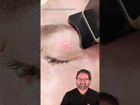 Eyelid CO2 Laser Treatment- Surgeon Reacts