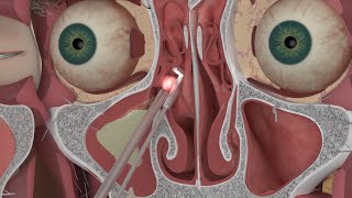 Chapter 3: Nasal and Sinus Problems and Solutions