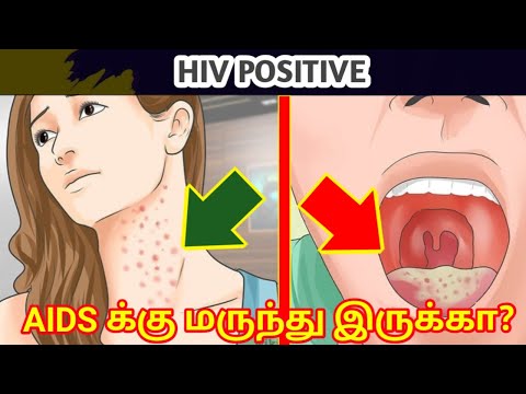 AIDS symptoms in Tamil/AIDS in Tamil/hiv explained in tamil/aids explained tamil/hiv symptoms tamil