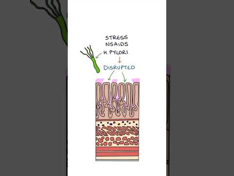 Peptic Ulcers #medicine #medicalstudent #gastroenterology