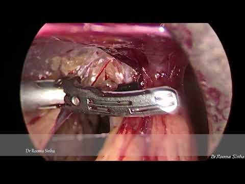 Laparoscopic Hysterectomy TLH for  Endometriosis & adenomyosis Dr Rooma Sinha Apollo, Hyderabad