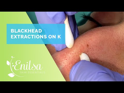 Blackhead Extractions on K - Merry Christmas!