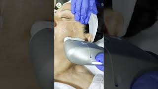 Best HIFU Treatment in Delhi | Care Well Medical Centre #shorts