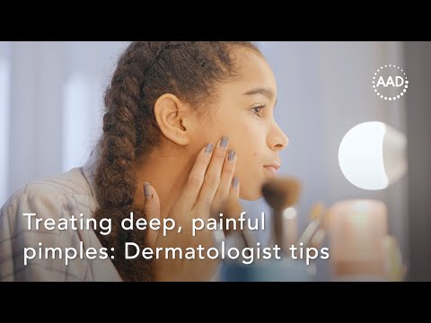 Treating deep, painful pimples: Dermatologist tips