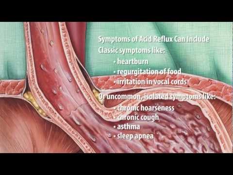 What is Acid reflux? Acid reflux explained by Dr. Simon Cofrancesco